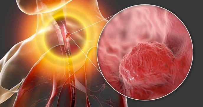 Los síntomas del cáncer de esófago y la importancia del por qué no ignorarlos