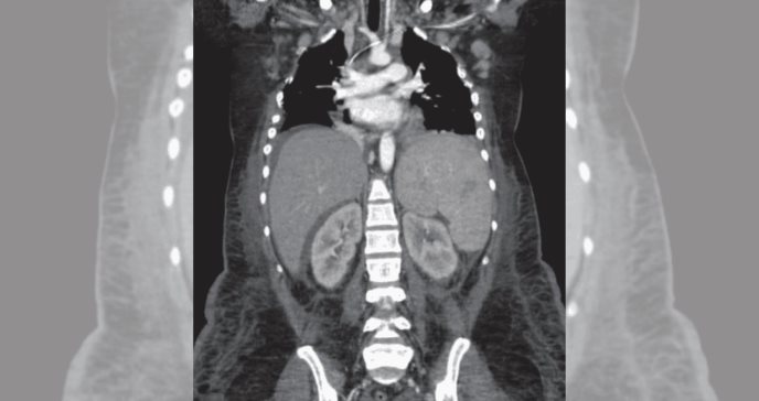 Caso inusual de lesión renal por lupus eritematoso sistémico con afectación multiorgánica