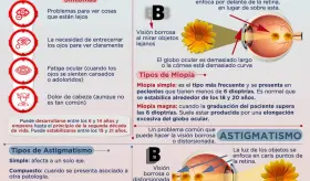 Miop&iacute;a y astigmatismo - Infograf&iacute;a