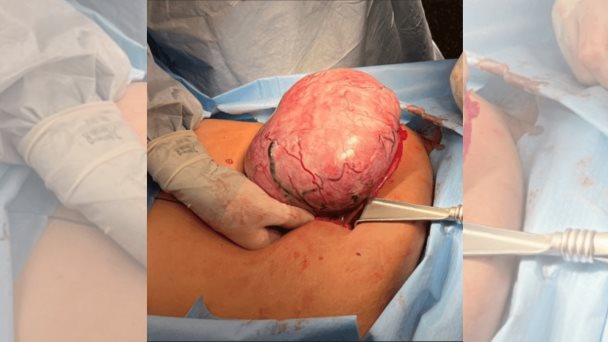 Niña de 12 años es diagnosticada con un tumor de células de la granulosa juvenil en el ovario Niña de 12 años es diagnosticada con un tumor de células de la granulosa juvenil en el ovario