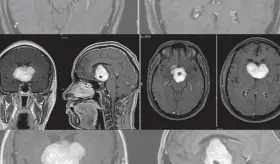 Paciente con psicosis y depresión mayor desarrolla glioma cordoide, tumor cerebral poco frecuente