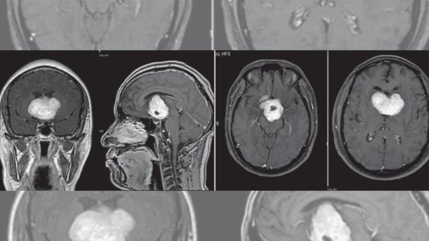 Paciente con psicosis y depresión mayor desarrolla glioma cordoide, tumor cerebral poco frecuente Paciente con psicosis y depresión mayor desarrolla glioma cordoide, tumor cerebral poco frecuente