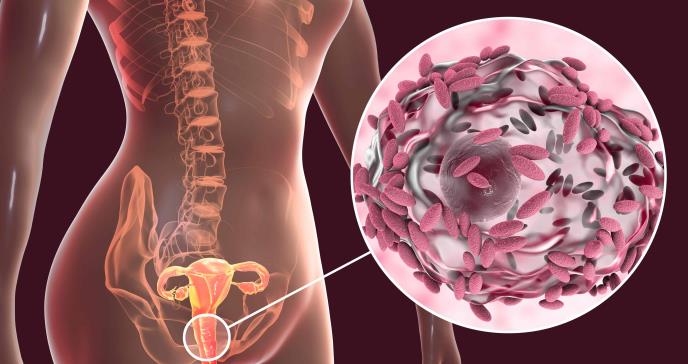 Vaginosis bacteriana asociada con infecciones persistentes de Virus del Papiloma Humano