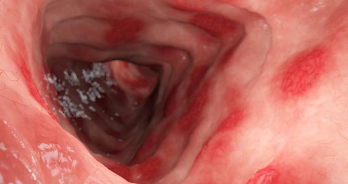 Combinación de hierbas Curcumina y Qing-Dai logran controlar la colitis ulcerosa activa: estudio