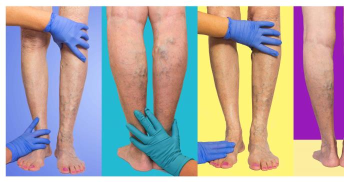 Insuficiencia venosa, varices y trombosis, las enfermedades venosas más comunes