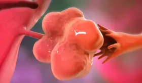 5 datos claves que debes conocer sobre el Síndrome de Ovario Micropoliquístico