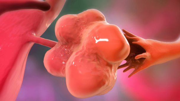 Síndrome de ovario poliquístico tendrá un impacto directo en futuras generaciones masculinas Síndrome de ovario poliquístico tendrá un impacto directo en futuras generaciones masculinas