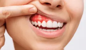 Hipersensibilidad dentinaria debido a caries, blanqueamientos o desgaste del esmalte dental