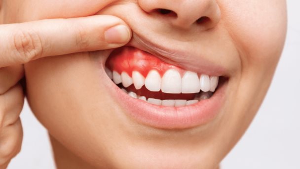 Hipersensibilidad dentinaria debido a caries, blanqueamientos o desgaste del esmalte dental Hipersensibilidad dentinaria debido a caries, blanqueamientos o desgaste del esmalte dental