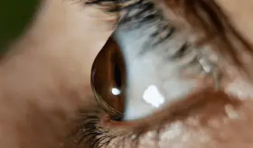 Cuidado con la frotaci&oacute;n excesiva en los ojos, podr&iacute;a desarrollar queratocono sin darse cuenta