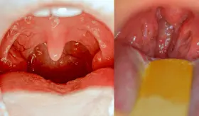 Amigdalectomía: el procedimiento para tratar amigdalitis bacteriana y la apnea obstructiva del sueño