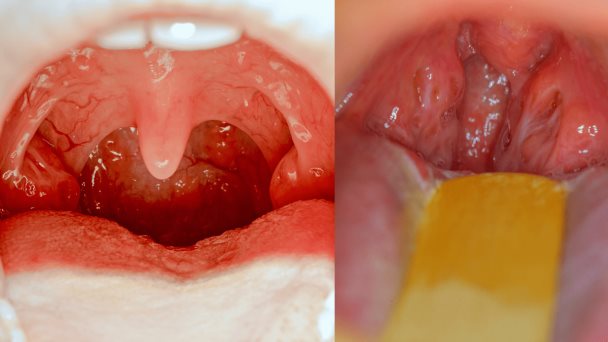 Amigdalectomía: el procedimiento para tratar amigdalitis bacteriana y la apnea obstructiva del sueño