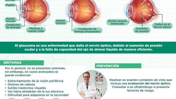 Glaucoma - Infografía Glaucoma - Infografía