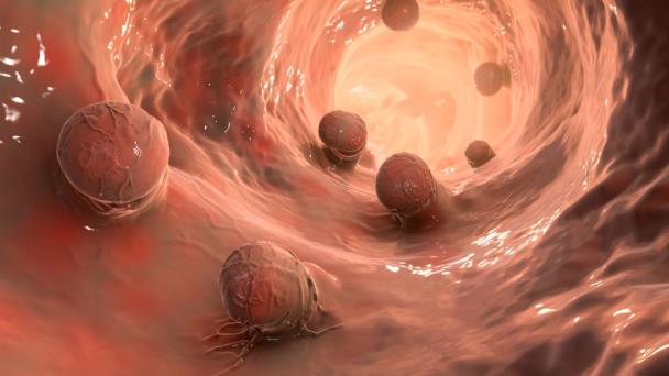 Pólipos intestinales: ¿enemigos silenciosos del colon?