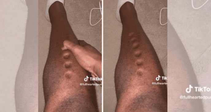 “Piel de plastilina”: la patología que sufre un atleta olímpico y es viral en redes