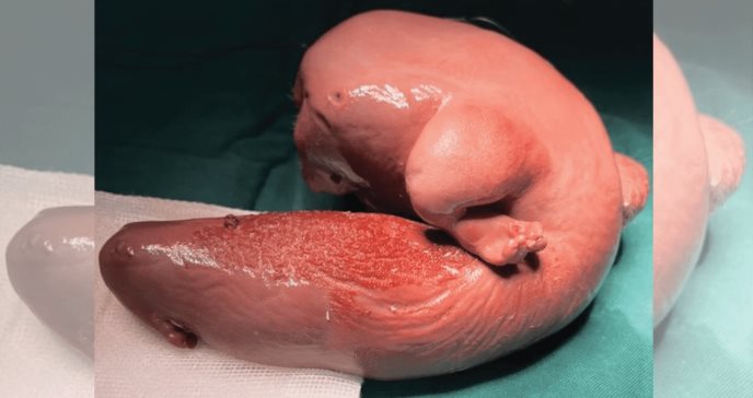 Raro caso de Fetus-in-fetu: gemelo malformado crece en el cerebro de una niña de 1 año