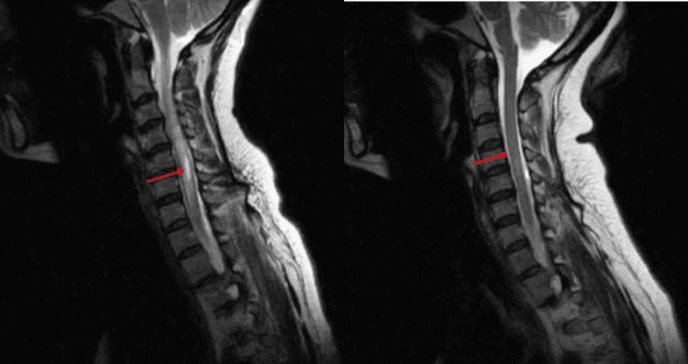 Puertorriqueña fue diagnosticada con neuromielitis óptica 15 años después de presentar hipo intratable