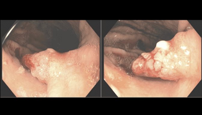 Paciente de 73 años presentó causa inusual de pérdida de sangre gastrointestinal