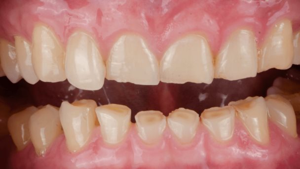 ¿Rechinas los dientes dormido? Conoce sobre el bruxismo de sueño y su relación con la actividad cardíaca ¿Rechinas los dientes dormido? Conoce sobre el bruxismo de sueño y su relación con la actividad cardíaca