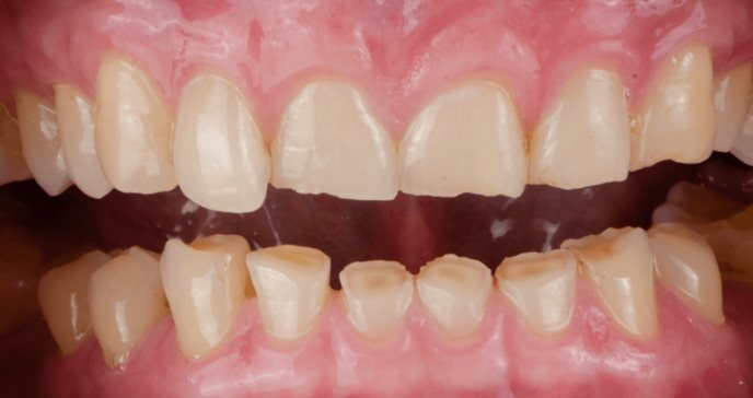 ¿Rechinas los dientes dormido? Conoce sobre el bruxismo de sueño y su relación con la actividad cardíaca