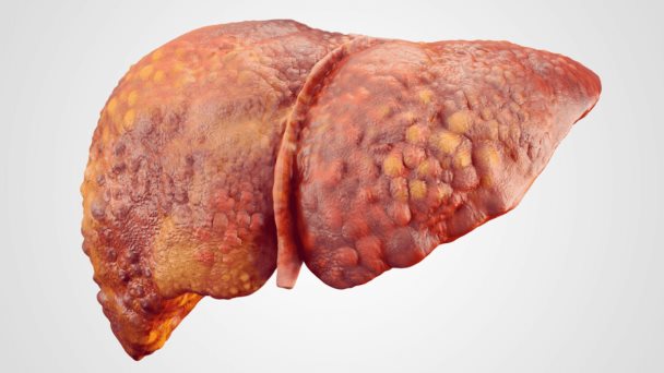 Ictericia, náuseas, hepatomegalia y otros síntomas de daño hepático inducido por medicamentos