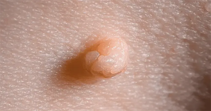 No todas las verrugas genitales son por VPH: verruga de agua y otros tipos que puede identificar No todas las verrugas genitales son por VPH: verruga de agua y otros tipos que puede identificar