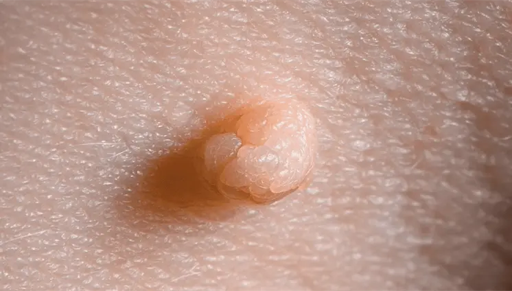 No todas las verrugas genitales son por VPH: verruga de agua y otros tipos que puede identificar No todas las verrugas genitales son por VPH: verruga de agua y otros tipos que puede identificar