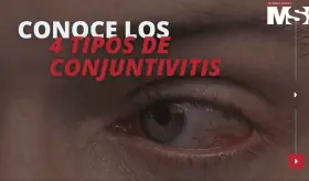 Conoce los 4 tipos de conjuntivitis #C&aacute;psulaEspecial