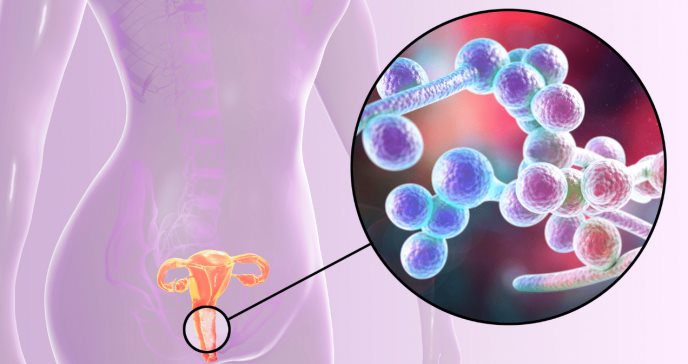 Uso de antibióticos o lavados vaginales: causa común de las infecciones vulvovaginales