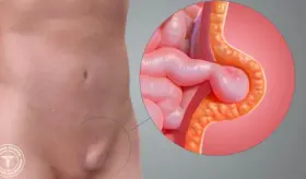 ¿Por qué ocurren las hernias inguinales y qué tienen que ver la tos crónica o el estreñimiento con ellas?