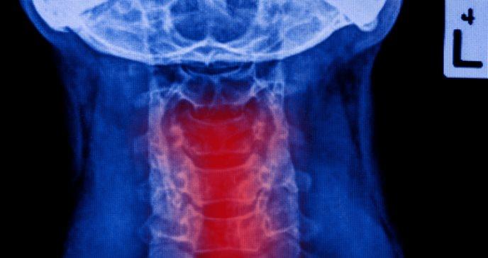 Síntomas podrían predecir fracaso del tratamiento y muerte en el cáncer de orofaringe