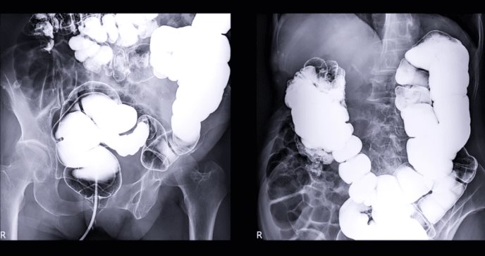 Estudio de Puerto Rico evalúa el impacto de la pandemia de COVID-19 en el cáncer colorrectal