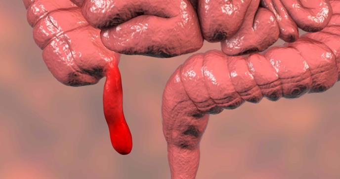 Perforaciones en el apéndice y apendicitis: reconozca los síntomas a tiempo