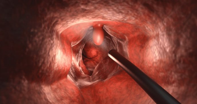 ¿En qué consiste la colonoscopia? El examen clave para detectar el cáncer de colon