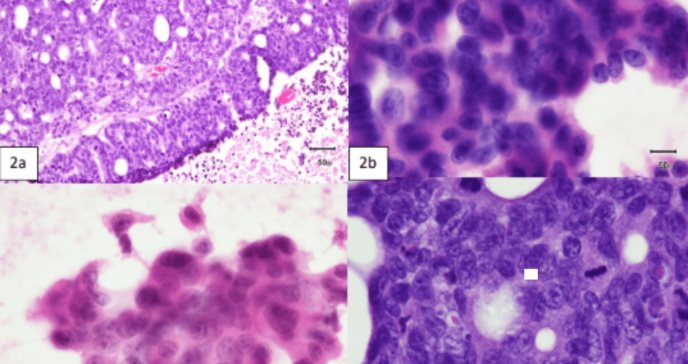 Extraño caso de adenocarcinoma de colon asintomático con metástasis al cerebro en hombre puertorriqueño