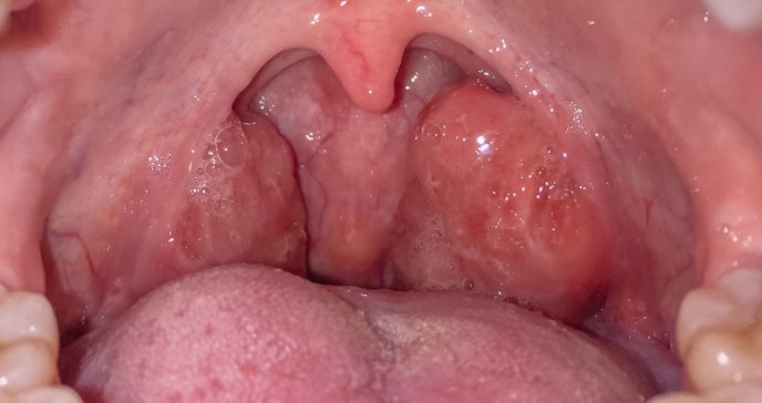 Mononucleosis infecciosa o enfermedad del beso y sus signos en amígdalas, hígado, bazo o ganglios