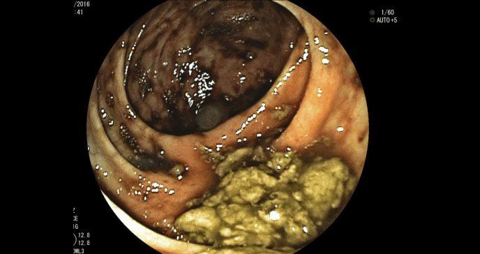 Encuentran relación de trombosis venosa esplácnica en casos de cáncer gastrointestinal