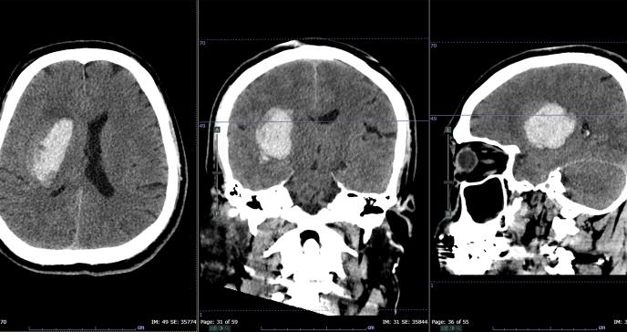 Hipertensión arterial o presión alta en los 30 años se asocia con peor salud cerebral en la tercera edad