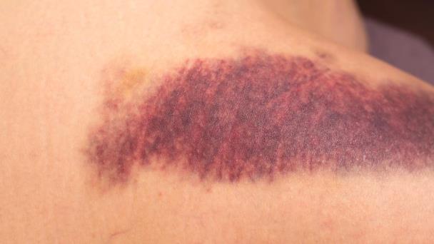 Diferencias entre hemofilia y la Enfermedad de Von Willebrand Diferencias entre hemofilia y la Enfermedad de Von Willebrand