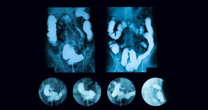 Medicamentos pueden aumentar el riesgo de cáncer del intestino grueso, señalan expertos