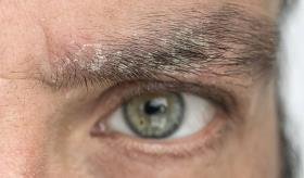 Dermatitis atópica: criterios diagnósticos y exacerbaciones asociadas a la condición