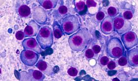 Criterios diagnósticos y manejo del mieloma múltiple