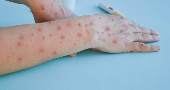 “Inmunidad en red”: La protección natural que ha frenado el brote mundial de la Mpox