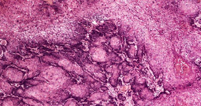 Advierten investigadores: Virus del Papiloma Humano podría desarrollar cáncer en