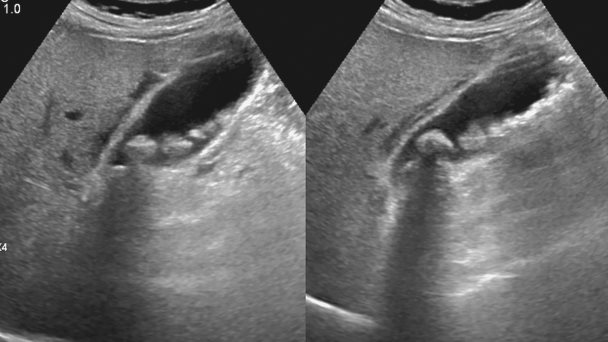 Relación entre el funcionamiento de la vesícula y el dolor de espalda o cervical Relación entre el funcionamiento de la vesícula y el dolor de espalda o cervical