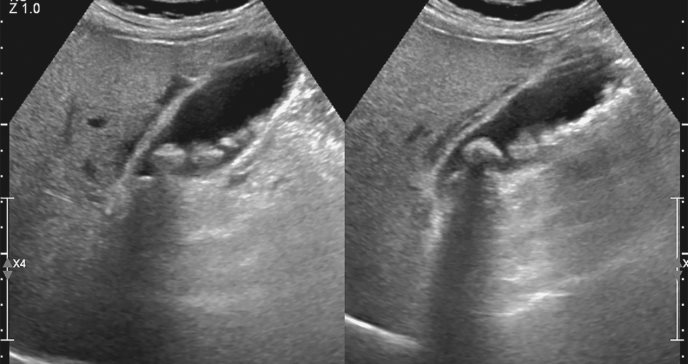 Relación entre el funcionamiento de la vesícula y el dolor de espalda o cervical