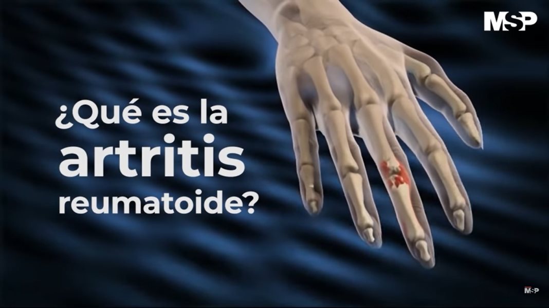 ¿Qué es la artritis reumatoide? #ExclusivoMSP