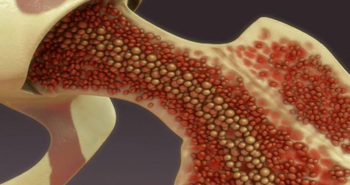 Ictus óseo: cuando las anomalías cartilaginosas u óseas causan embolias e infartos cerebrales