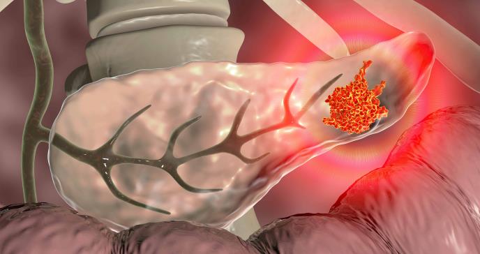Pérdida de peso, ictericia, vómito y otros síntomas del cáncer de páncreas 