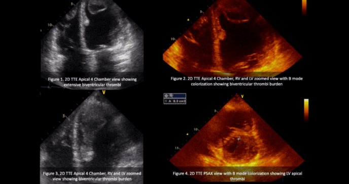 Mujer hispana diagnosticada con miocardiopatía periparto sufre complicación fatal